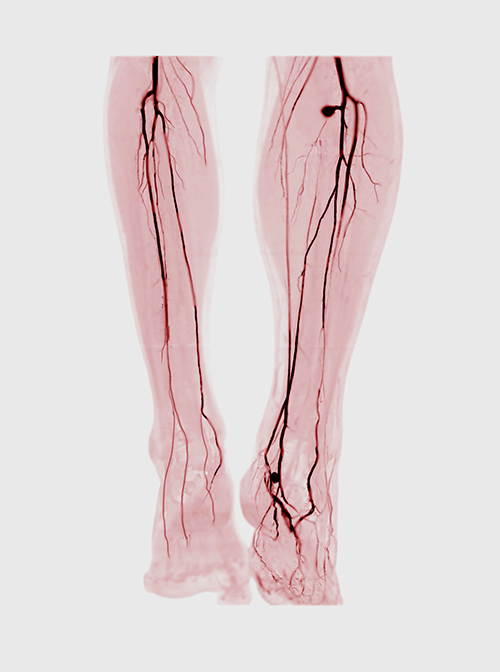 Angiogram demonstrating peripheral artery disease